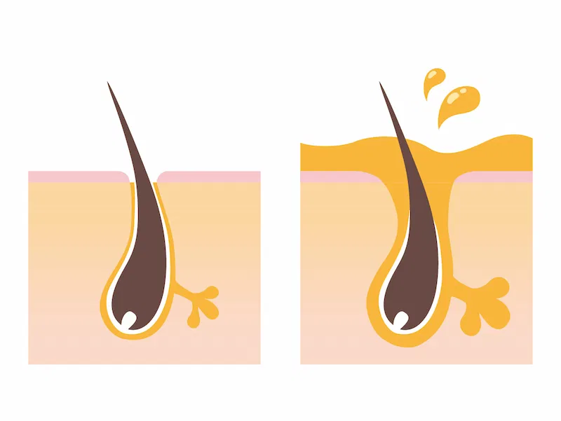 ニキビなどの肌トラブル